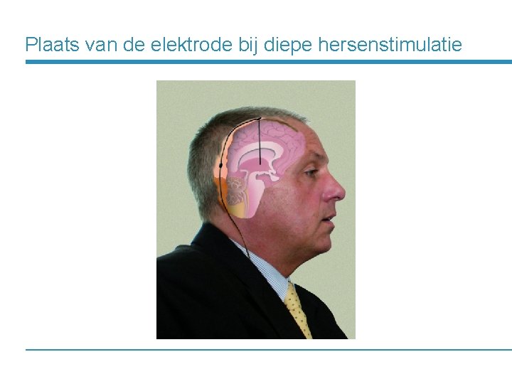Plaats van de elektrode bij diepe hersenstimulatie 
