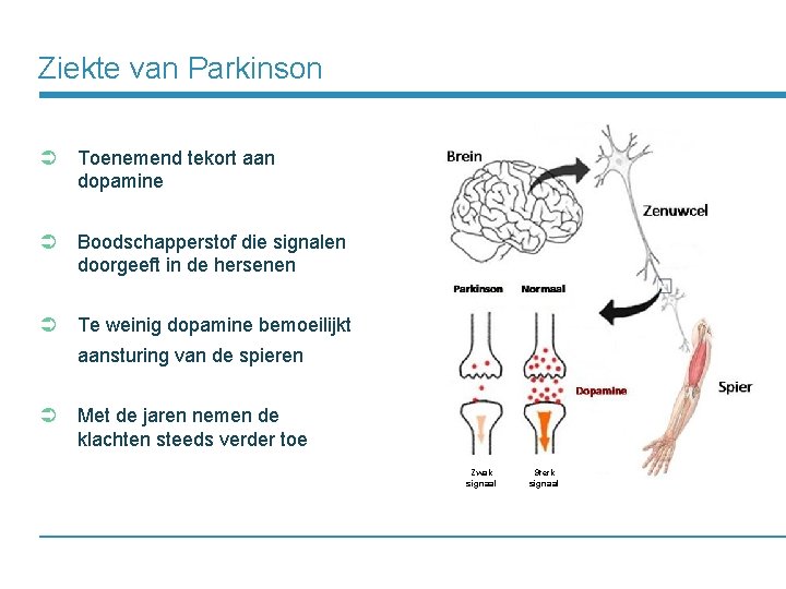 Ziekte van Parkinson Ü Toenemend tekort aan dopamine Ü Boodschapperstof die signalen doorgeeft in
