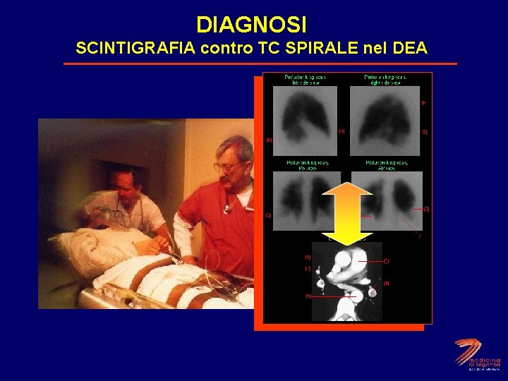 DIAGNOSI SCINTIGRAFIA contro TC SPIRALE nel DEA 