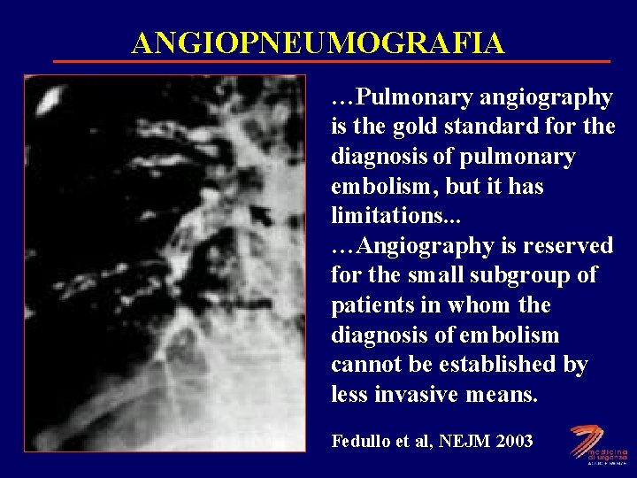 ANGIOPNEUMOGRAFIA …Pulmonary angiography is the gold standard for the diagnosis of pulmonary embolism, but