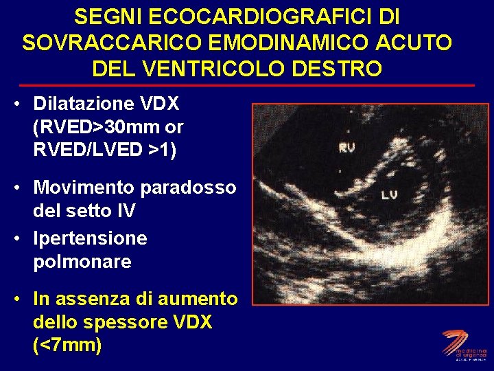 SEGNI ECOCARDIOGRAFICI DI SOVRACCARICO EMODINAMICO ACUTO DEL VENTRICOLO DESTRO • Dilatazione VDX (RVED>30 mm
