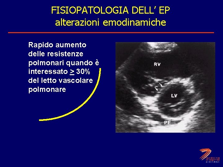 Resistenze polmonari FISIOPATOLOGIA DELL’ EP alterazioni emodinamiche Rapido aumento delle resistenze polmonari quando è
