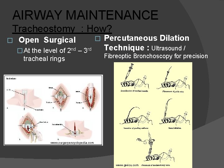 AIRWAY MAINTENANCE Tracheostomy : How? � Open Surgical � At the level of 2