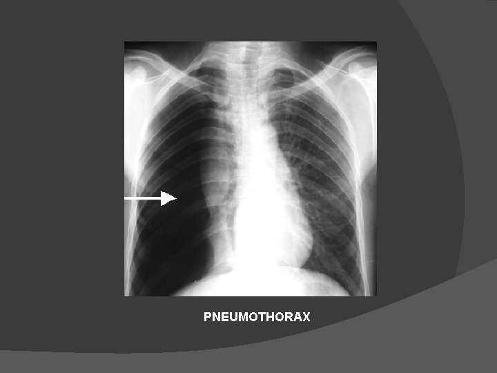 PNEUMOTHORAX 
