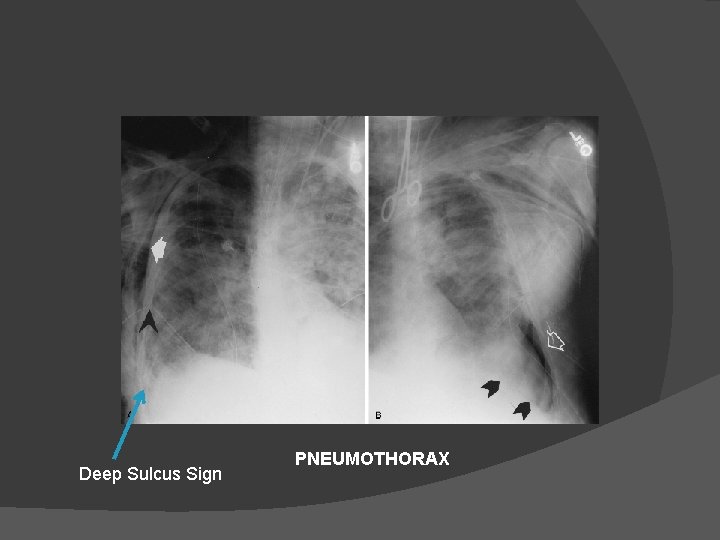 Deep Sulcus Sign PNEUMOTHORAX 
