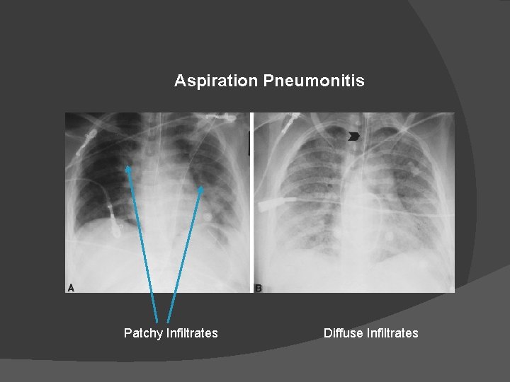 Aspiration Pneumonitis Patchy Infiltrates Diffuse Infiltrates 