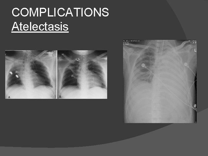 COMPLICATIONS Atelectasis 