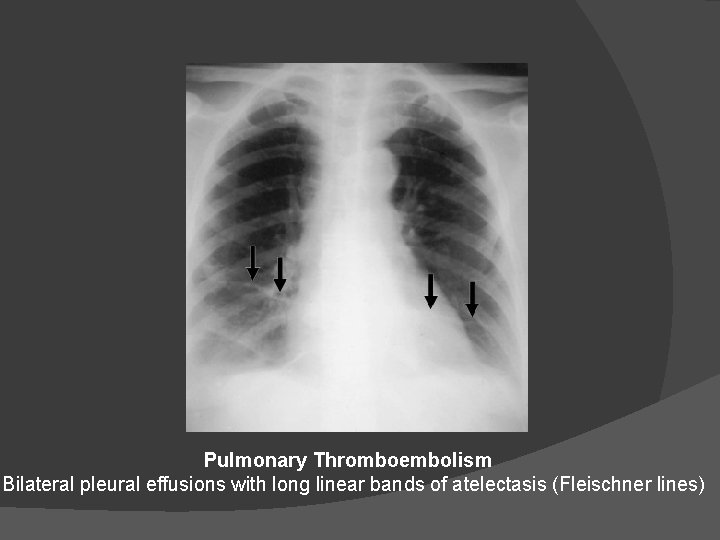 Pulmonary Thromboembolism Bilateral pleural effusions with long linear bands of atelectasis (Fleischner lines) 