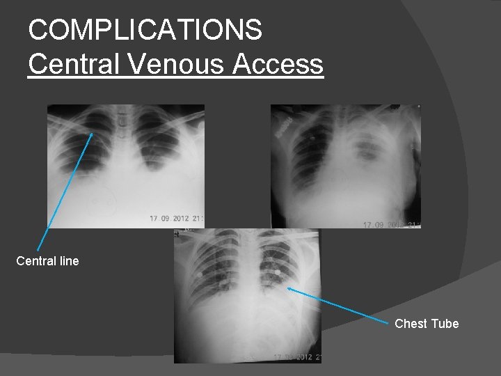 COMPLICATIONS Central Venous Access Central line Chest Tube 
