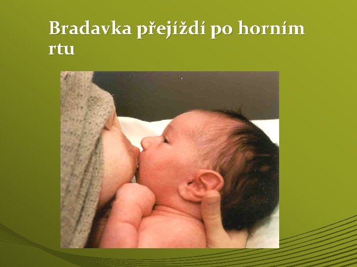 Bradavka přejíždí po horním rtu 