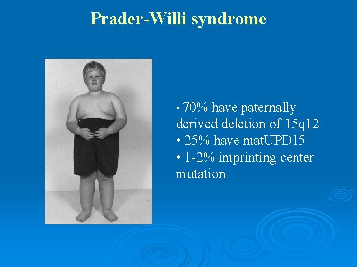 Prader-Willi syndrome • 70% have paternally derived deletion of 15 q 12 • 25%