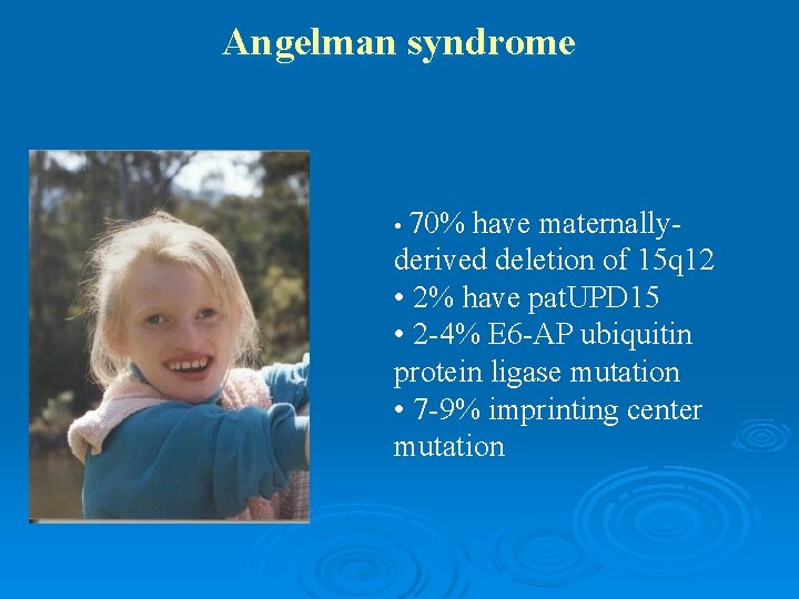 Angelman syndrome • 70% have maternallyderived deletion of 15 q 12 • 2% have