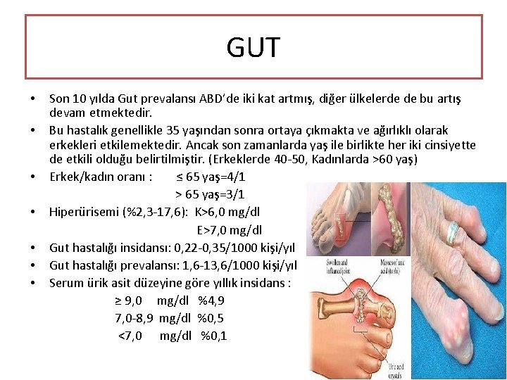 GUT • • Son 10 yılda Gut prevalansı ABD’de iki kat artmış, diğer ülkelerde