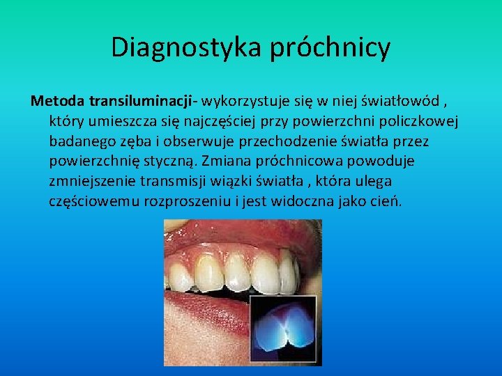 Diagnostyka próchnicy Metoda transiluminacji- wykorzystuje się w niej światłowód , który umieszcza się najczęściej