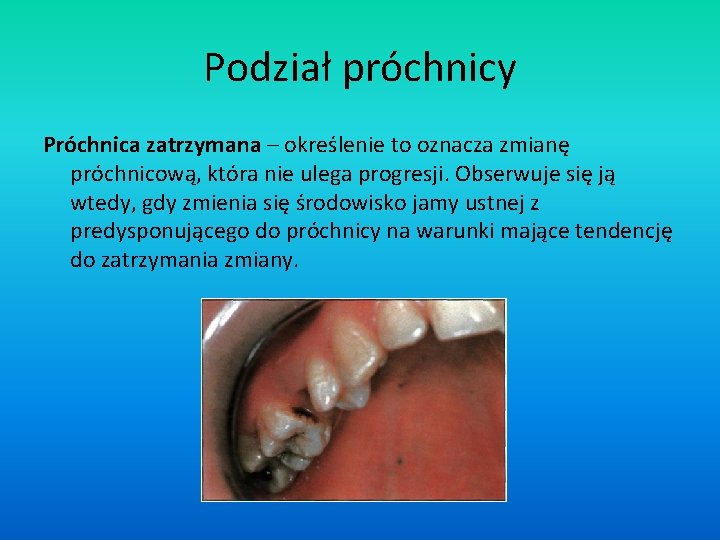 Podział próchnicy Próchnica zatrzymana – określenie to oznacza zmianę próchnicową, która nie ulega progresji.