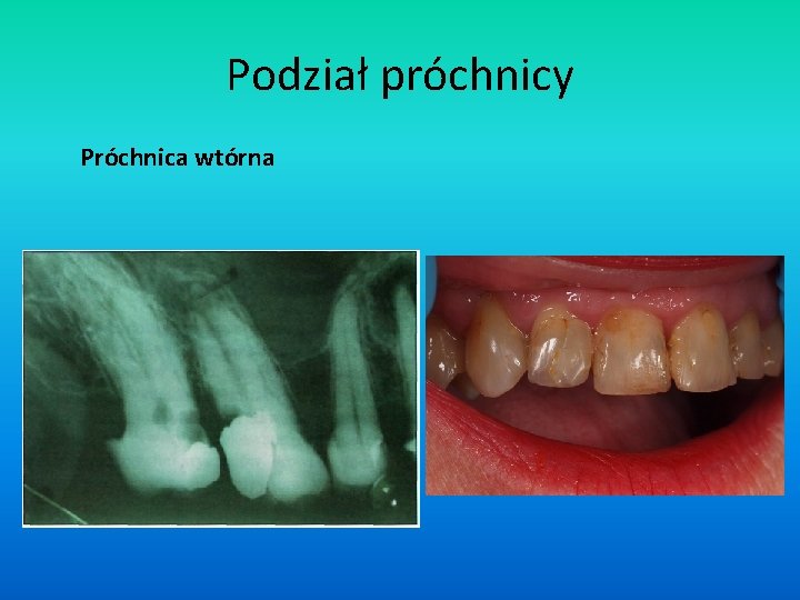 Podział próchnicy Próchnica wtórna 