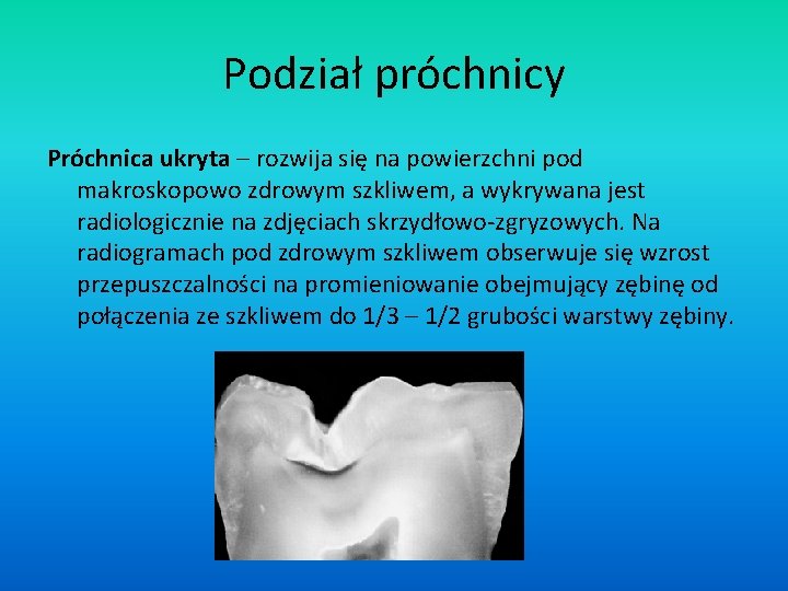 Podział próchnicy Próchnica ukryta – rozwija się na powierzchni pod makroskopowo zdrowym szkliwem, a