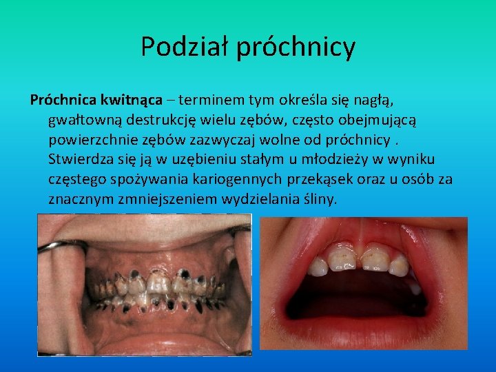 Podział próchnicy Próchnica kwitnąca – terminem tym określa się nagłą, gwałtowną destrukcję wielu zębów,