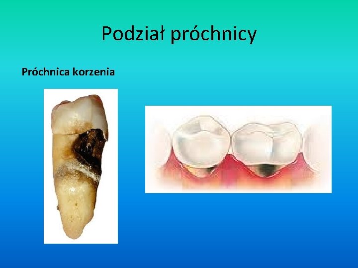 Podział próchnicy Próchnica korzenia 