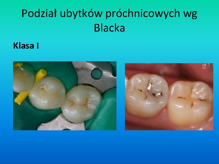 Podział ubytków próchnicowych wg Blacka Klasa I 