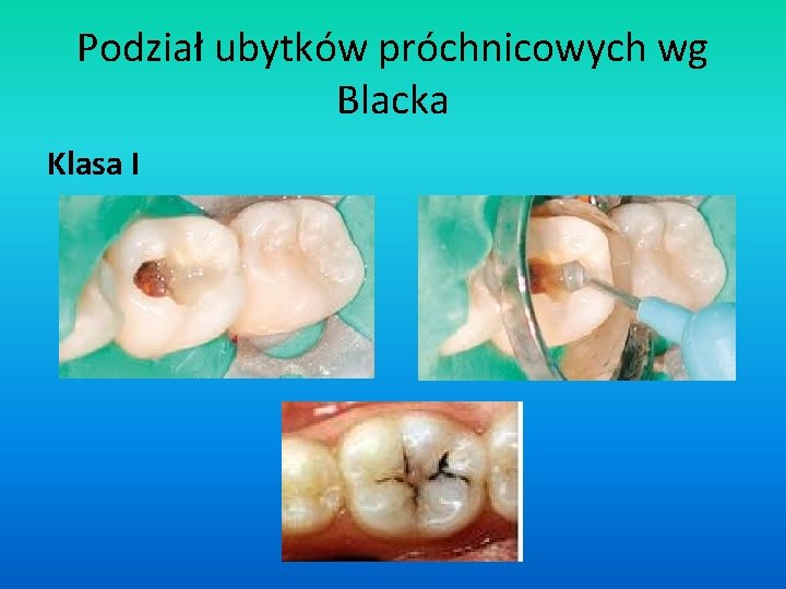 Podział ubytków próchnicowych wg Blacka Klasa I 