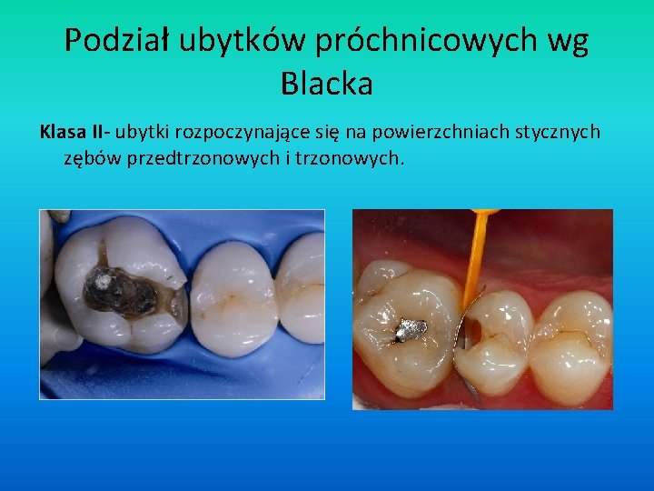 Podział ubytków próchnicowych wg Blacka Klasa II- ubytki rozpoczynające się na powierzchniach stycznych zębów