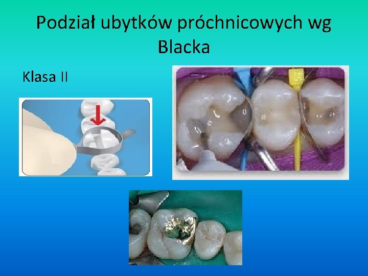 Podział ubytków próchnicowych wg Blacka Klasa II 