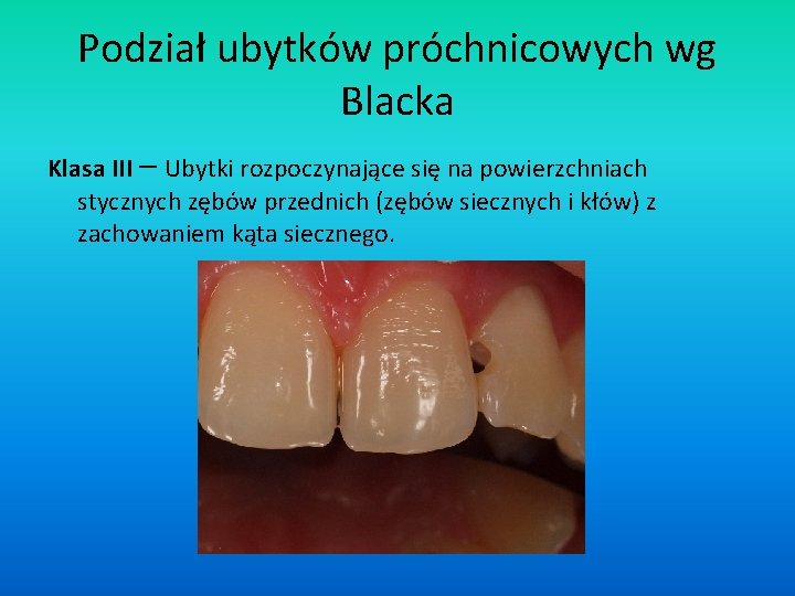 Podział ubytków próchnicowych wg Blacka Klasa III – Ubytki rozpoczynające się na powierzchniach stycznych