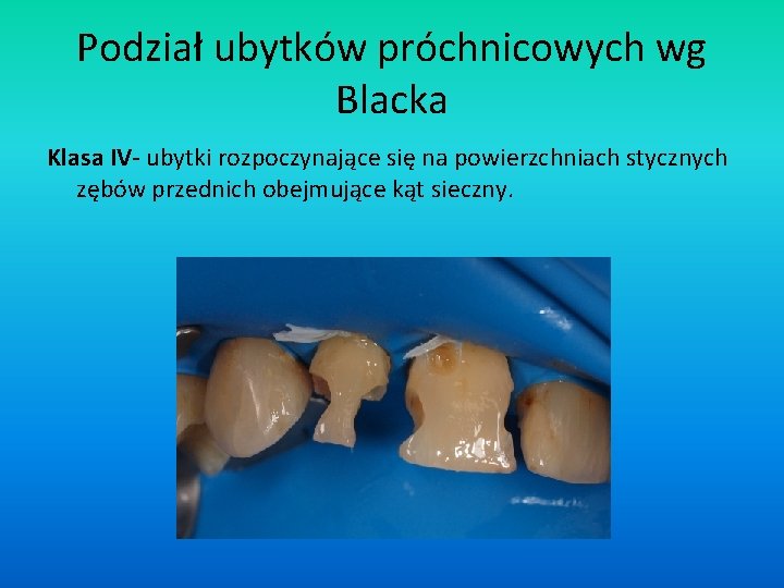 Podział ubytków próchnicowych wg Blacka Klasa IV- ubytki rozpoczynające się na powierzchniach stycznych zębów