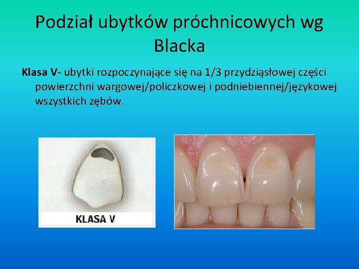 Podział ubytków próchnicowych wg Blacka Klasa V- ubytki rozpoczynające się na 1/3 przydziąsłowej części