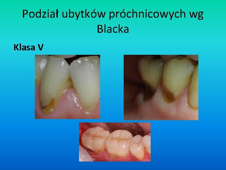 Podział ubytków próchnicowych wg Blacka Klasa V 