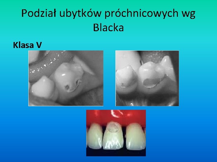 Podział ubytków próchnicowych wg Blacka Klasa V 