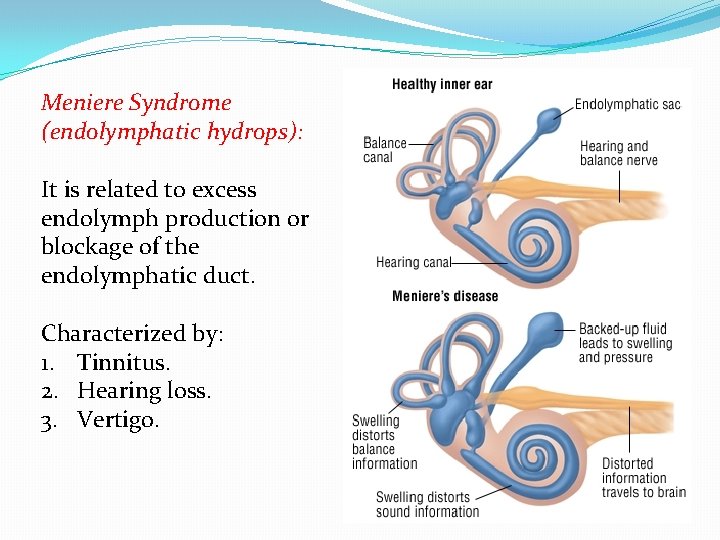 Meniere Syndrome (endolymphatic hydrops): It is related to excess endolymph production or blockage of