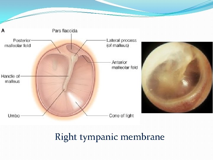 Right tympanic membrane 