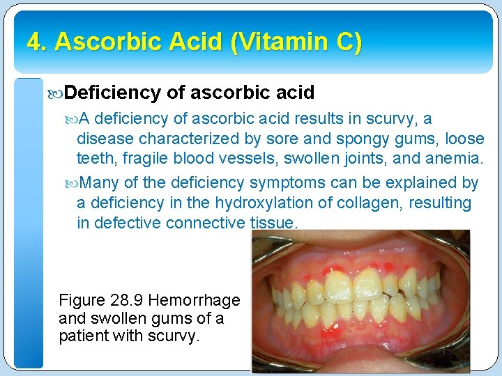 4. Ascorbic Acid (Vitamin C) Deficiency of ascorbic acid A deficiency of ascorbic acid