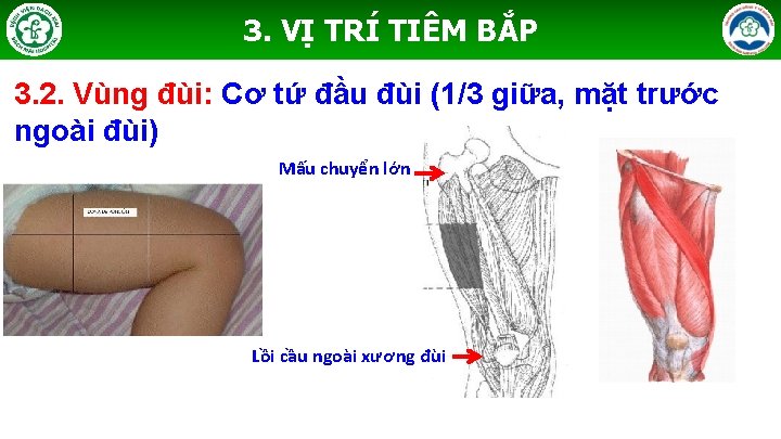 3. VỊ TRÍ TIÊM BẮP 3. 2. Vùng đùi: Cơ tứ đầu đùi (1/3