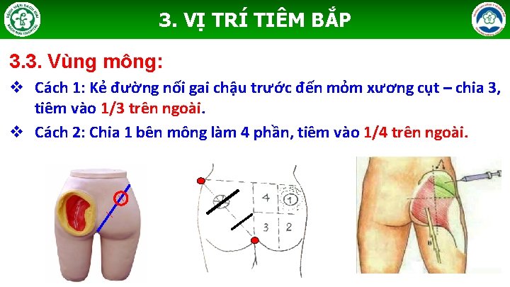 3. VỊ TRÍ TIÊM BẮP 3. 3. Vùng mông: v Cách 1: Kẻ đường