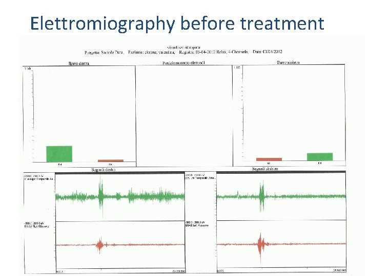 Elettromiography before treatment 