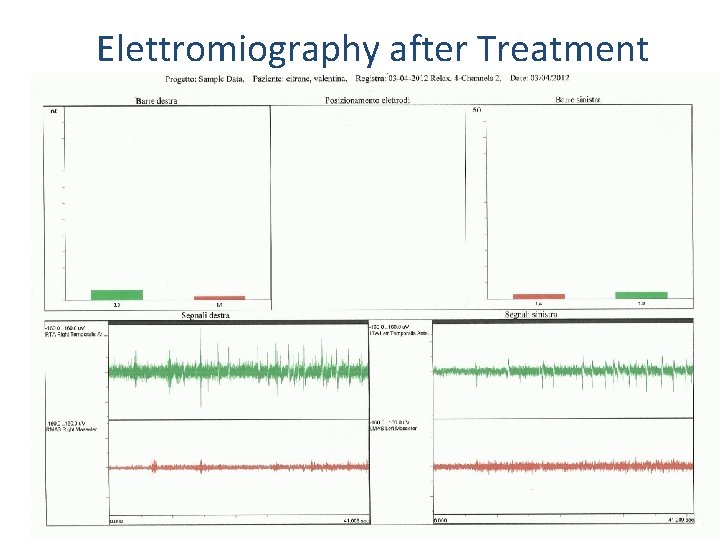 Elettromiography after Treatment 