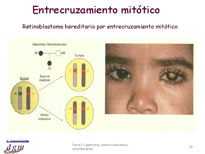 Entrecruzamiento mitótico Retinoblastoma hereditario por entrecruzamiento mitótico Dr. Antonio Barbadilla Tema 7: Ligamiento, entrecruzamiento