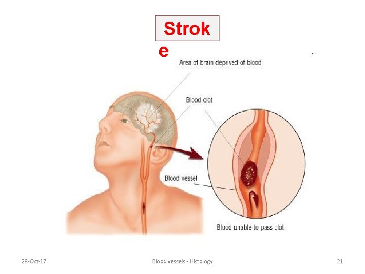 Strok e 28 -Oct-17 Blood vessels - Histology 21 