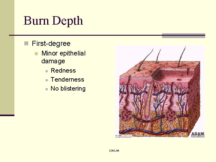 Burn Depth n First-degree n Minor epithelial damage n Redness n Tenderness n No