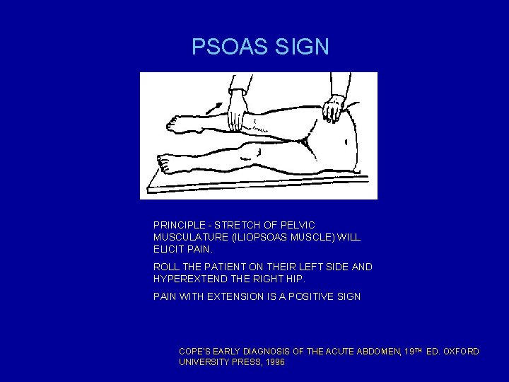 PSOAS SIGN PRINCIPLE - STRETCH OF PELVIC MUSCULATURE (ILIOPSOAS MUSCLE) WILL ELICIT PAIN. ROLL