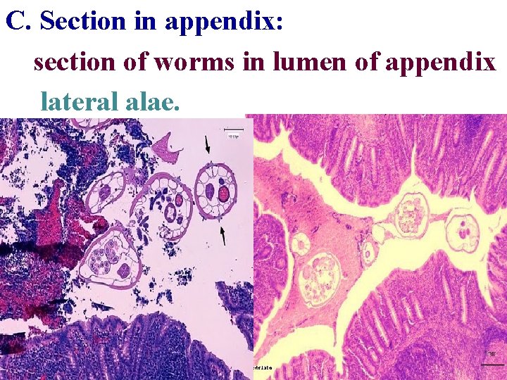 C. Section in appendix: section of worms in lumen of appendix lateral alae. 