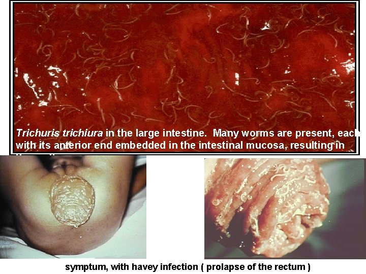 Trichuris trichiura in the large intestine. Many worms are present, each with its anterior
