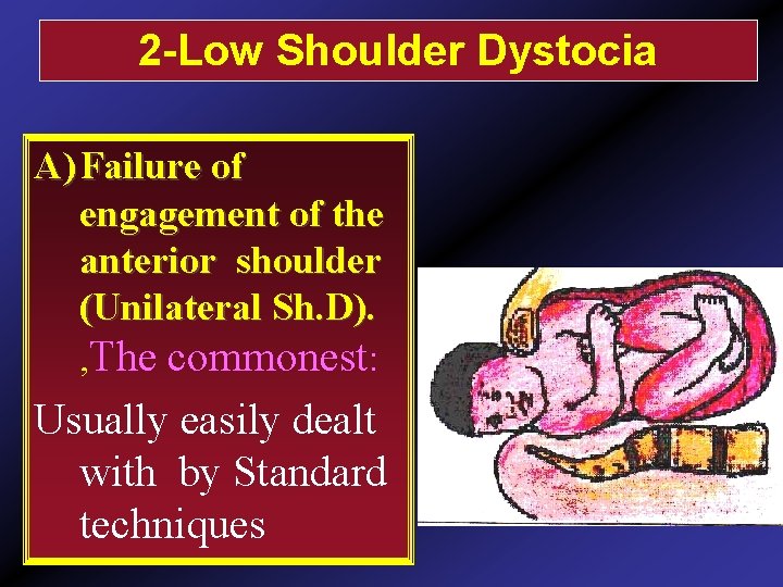 2 -Low Shoulder Dystocia A) Failure of engagement of the anterior shoulder (Unilateral Sh.