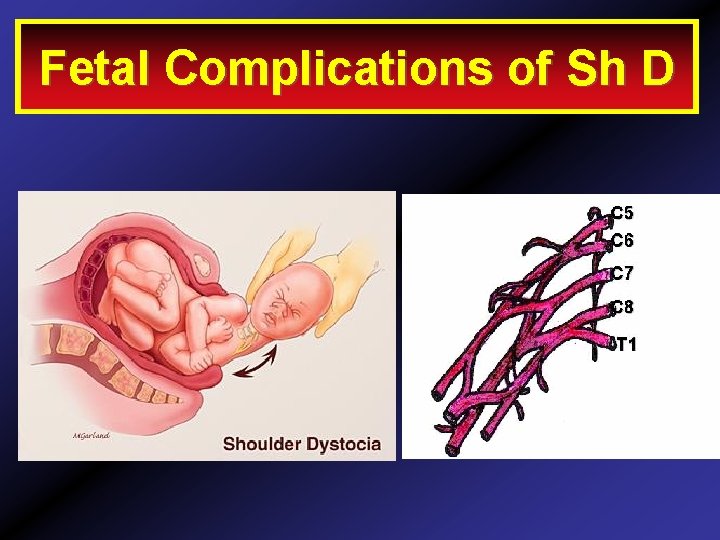 techniques Fetal. Release Complications of Sh D 