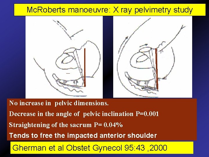 Mc. Roberts manoeuvre: X ray pelvimetry study No increase in pelvic dimensions. Decrease in