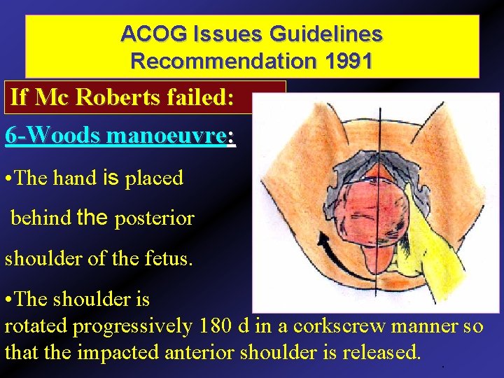 ACOG Issues Guidelines Recommendation 1991 If Mc Roberts failed: 6 -Woods manoeuvre: • The