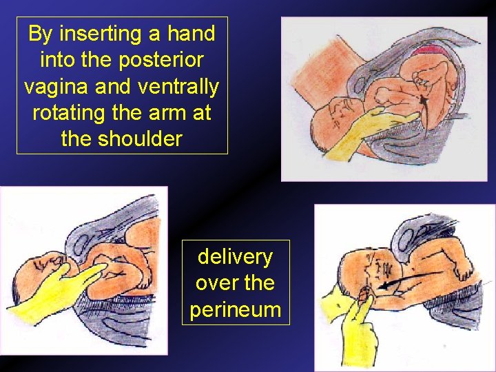 By inserting a hand into the posterior vagina and ventrally rotating the arm at